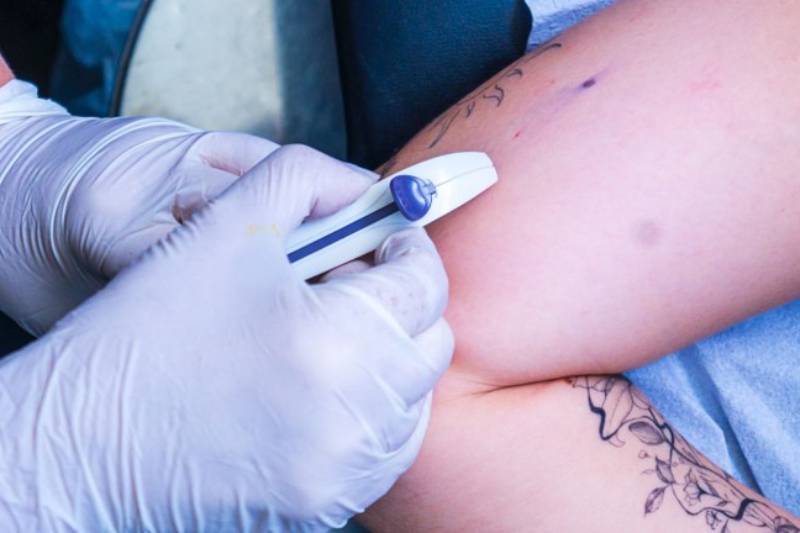 contraceptivo subdermico