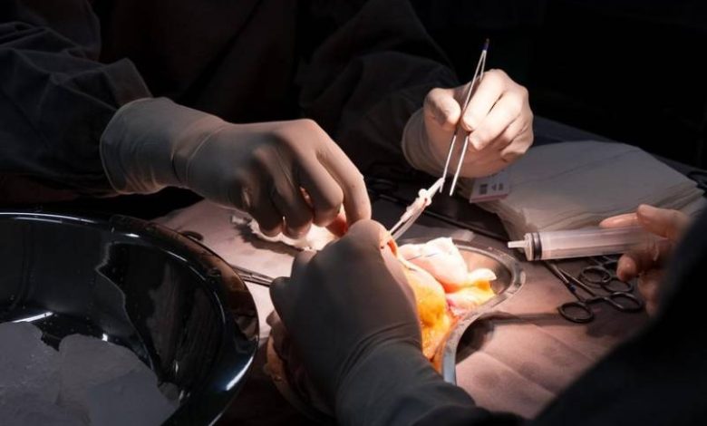 Paraíba realiza primeiro transplante renal 100% SUS no Hospital da Mulher 1 transplante renal hosp mulher