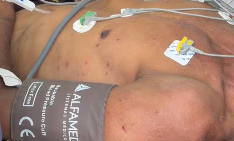 Ataque de abelhas deixa seis feridos em acampamento no Bairro das Indústrias, em João Pessoa 1 vitima picada abelha 121026